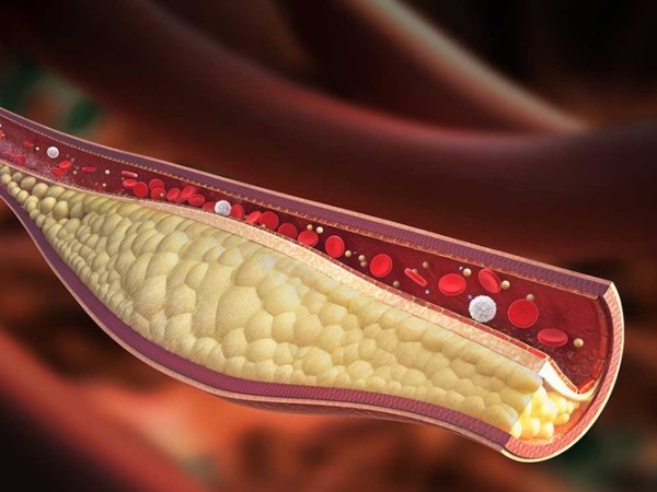 Cholesterol- What’s The Big&nbsp;Deal?
